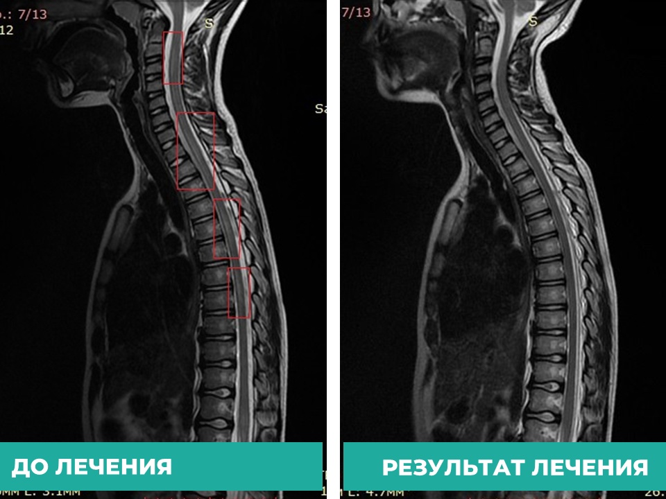 Кировские врачи спасли ребенка с серьезным воспалением спинного мозга